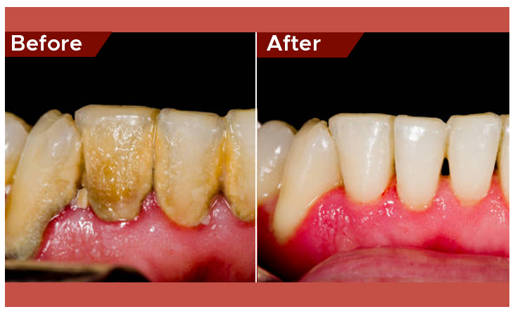 gum disease treatment in abu dhabi